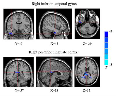 Abnormal Functional Connectivity Density in New-Onset Type 1 Diabetes Mellitus Children: A Resting-State Functional Magnetic Resonance Imaging Study